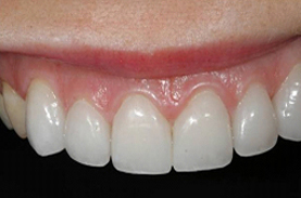 Cosmetic Periodontal surgery, Bleedign Gums, gum treatment, replace teeth