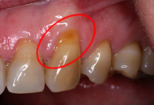 Gum recession and root coverage